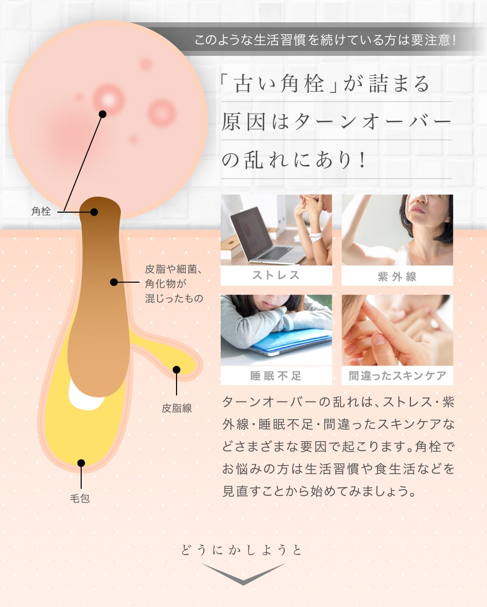 このような生活習慣を続けている方は要注意！「古い角栓」が詰まる原因はターンオーバーの乱れにあり！ストレス、紫外線、睡眠不足、間違ったスキンケア